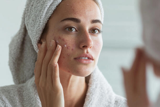 Fiziki maneələr və hormonlar: sızanaqdan necə qurtulmaq olar..?