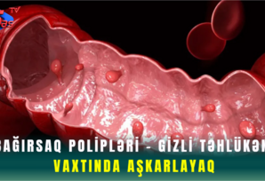 Bağırsaq Polipləri - Gizli Təhlükəni Vaxtında Aşkarlayaq